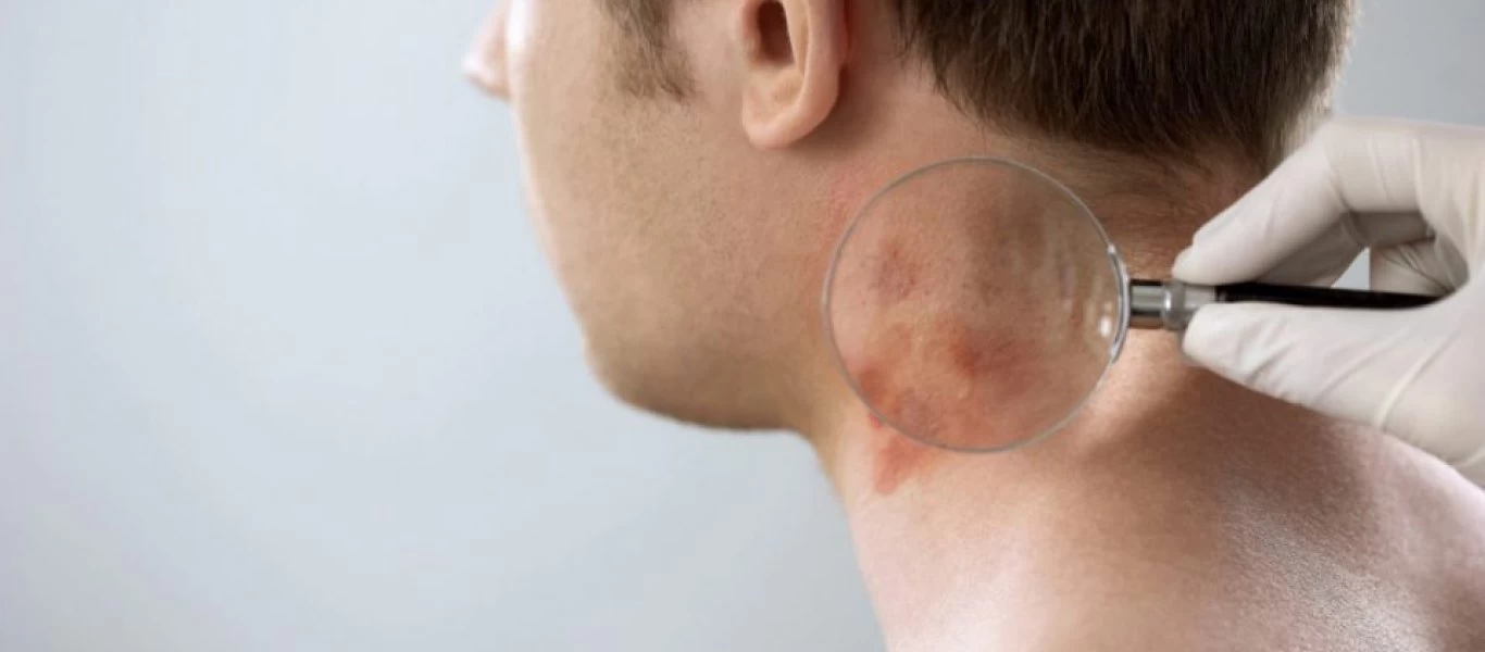 Η δερματική κατάσταση που συνδέεται με 13 είδη καρκίνου - Πως θα καταλάβετε ότι υπάρχει πρόβλημα